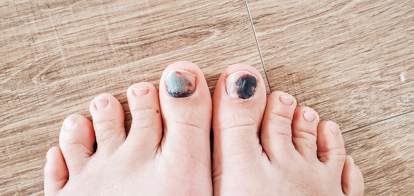 Bruised big toenails.